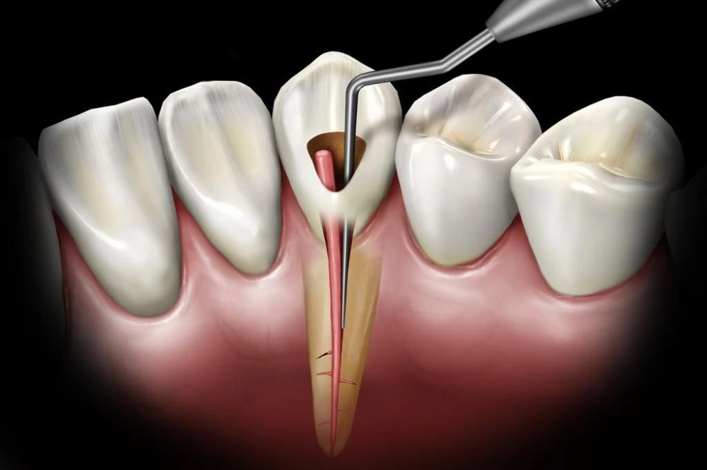 Traitement des canaux endodontie Casablanca